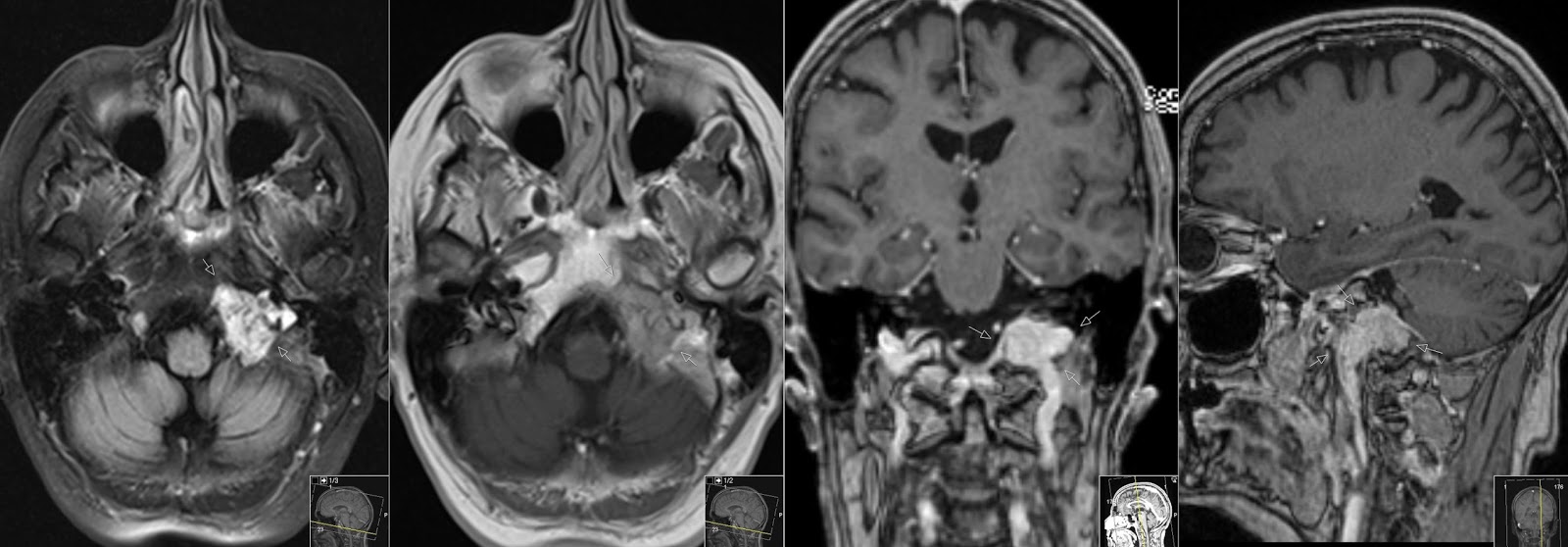 Paraganglioma Glomus Jugulare Radiology Imaging
