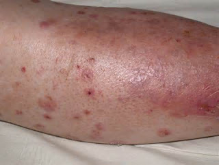 Diabetes Leg Swollen Pain: Diabetes legs sore? Why this is ...