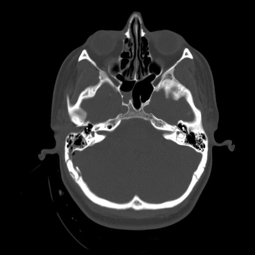 Post Gad: Trauma - Petrous Bone Fracture