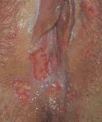 Penyakit herpes Pada kelamin