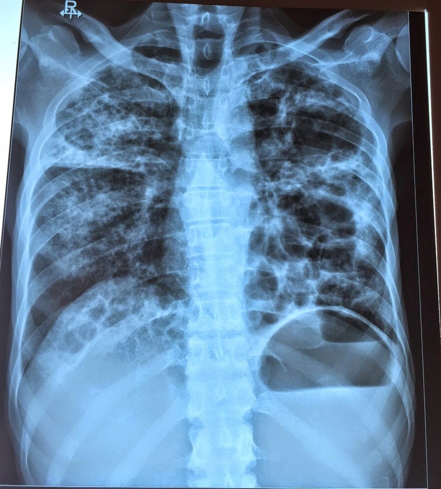 chest medicine made easy dr deepu radiology chest x ray spotters chest xray
