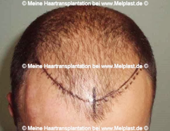 Kurz vor meiner Haartransplantation: die Einzeichnung der neuen Haarlinie.