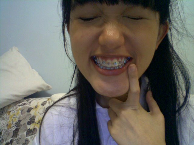 Braces Buck Teeth
