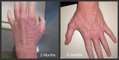 Best steroid cream for hands