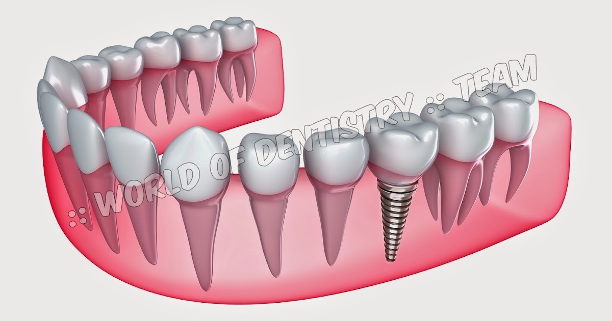  World Of Dentistry Contraindications of Dental Implants