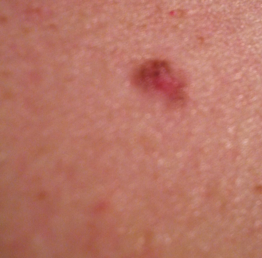 A Life Less Ordinary... Dermatology For Dummies In Treatment