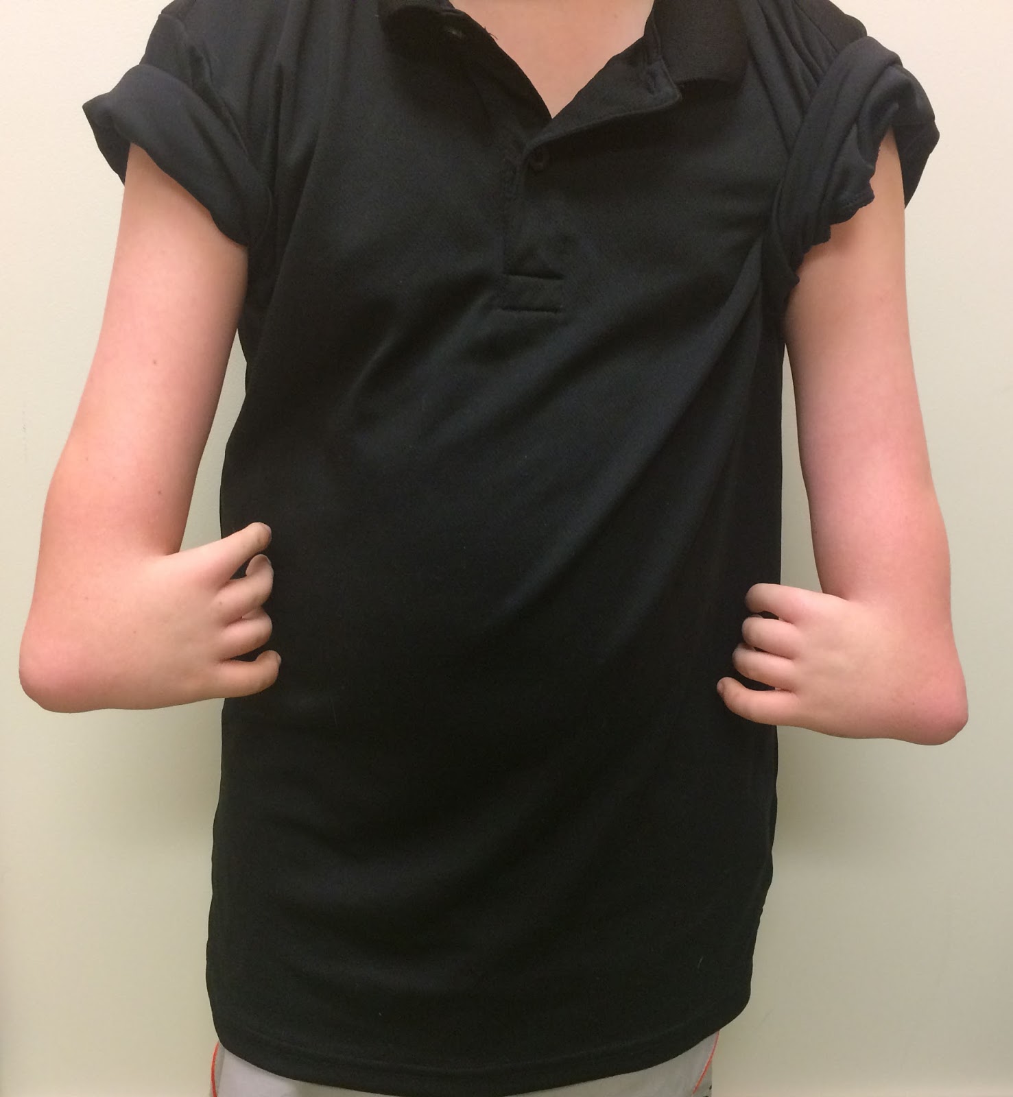 Radial Deficiency, Doing Fine Congenital Hand and Arm Differences