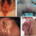 Obat sipilis mujarab thumbnail
