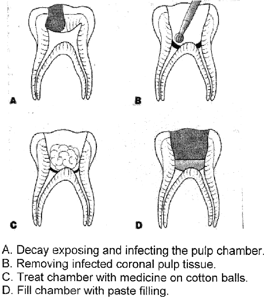 Pulp therapy for primary teeth Dentistry and Medicine
