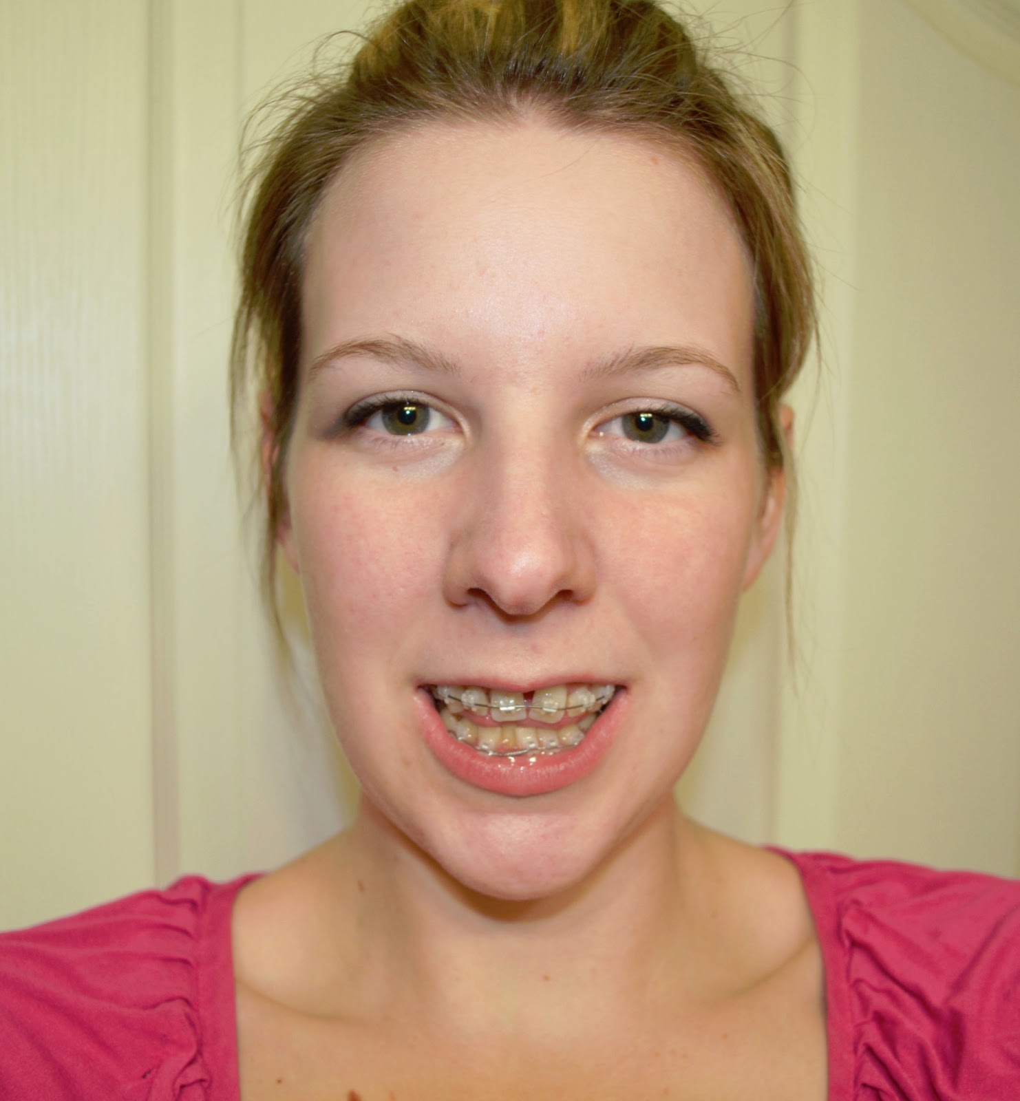 Amy's SARPE Adventure Owwwww ( Bottom braces on...