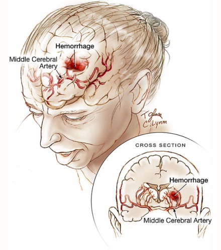 Gejala Stroke dan Pencegahan Ampuhnya Gejala Stroke dan Pencegahan Ampuhnya