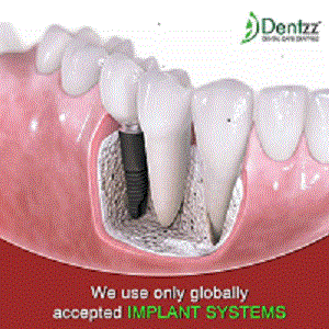  Dental Implants India