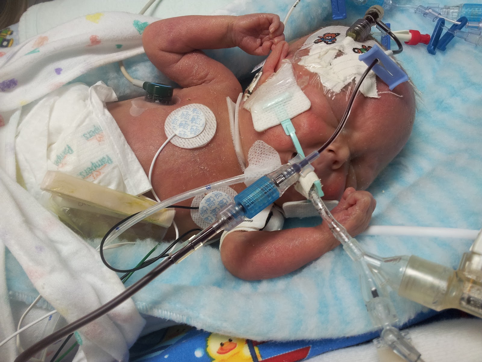 A Three E Circus Baby Eagan NICU Day 58 Sepsis