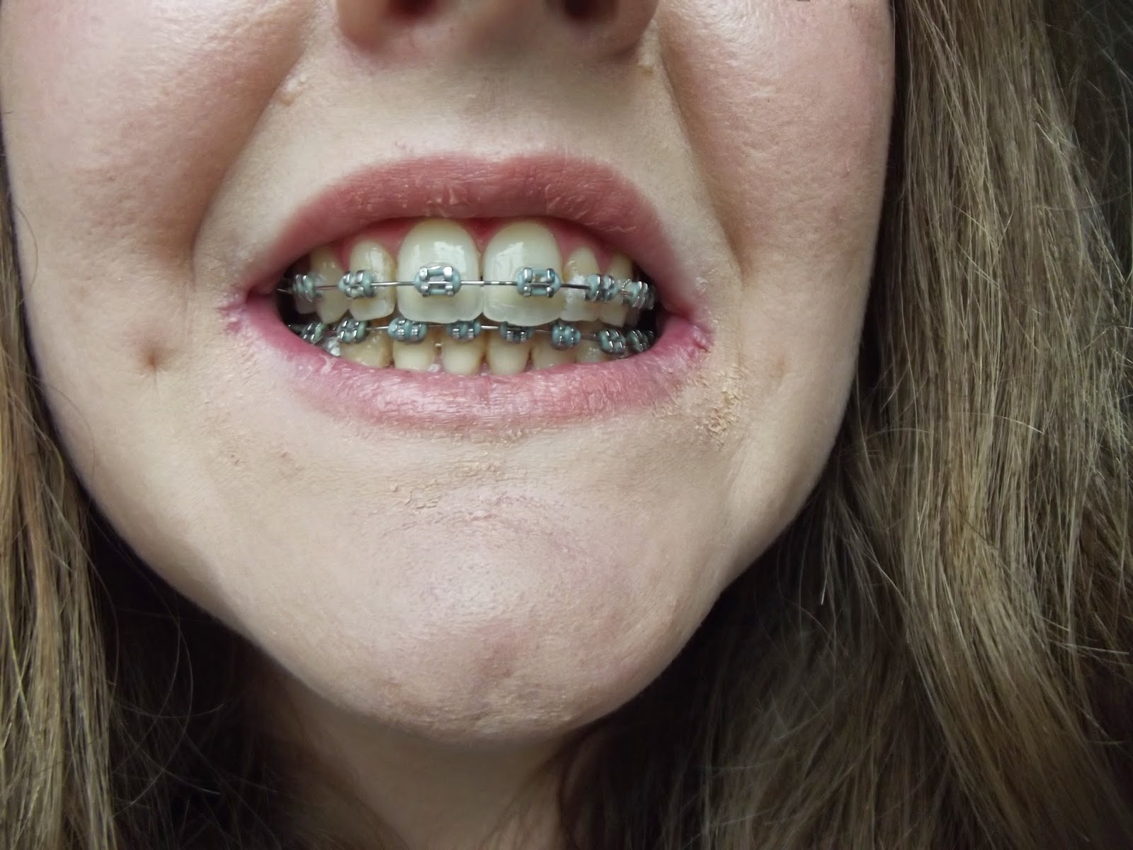 a photo of teeth with braces during orthodontic treatment