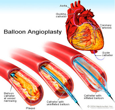 Balloon Angioplasty