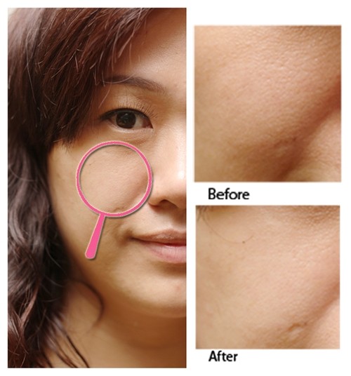 My Beautiful Life Charcoal Laser Treatment