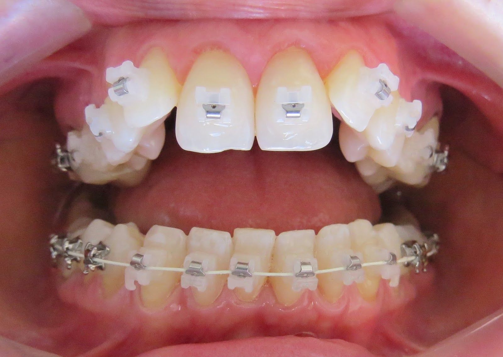 Aparelho Estético ou Metálico? (Tipos de Aparelhos)