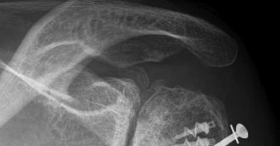 Shoulder Arthritis / Rotator Cuff Tears causes of