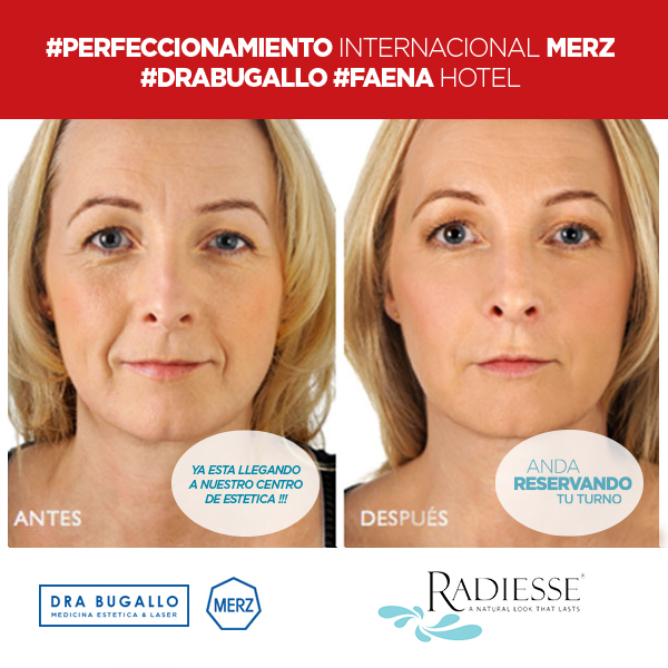 PERFECCIONAMIENTO INTERNACIONAL MERZ ( FAENA HOTEL). Gracias a Merz Aesthetics, Julio Zapico y Agustina Cattena por la formación continua, a la Dra Arbelia Bermúdez y muy especialmente a la Dra Tatjana Pavicic por la claridad formando y perfeccionándonos en las últimas técnicas de Fillers y Xeomin. #ChauArrugas #BienvenidaJuventud, #MamasMasLindas, #EsteticaBugallo, #DraBugallo #20PorcientoDeDescuento, #ChauArrugas, #BienvenidaJuventud. #ReservaTuTurno. Rellenos de #AcidoHialurónico y #EstimulacióndeColágeno (#Belotero + #Radiesse) + #ToxinaBotulinica (#Xeomin). Ya estan llegando los mejores e Innovadores Tratamientos Dermatológicos (XEOMIN, RADIESSE Y BELOTERO). #ChauArrugas #BienvenidaJuventud, #MamasMasLindas, #EsteticaBugallo, #DraBugallo. PERFECCIONAMIENTO INTERNACIONAL MERZ ( FAENA HOTEL). Gracias a Merz Aesthetics, Julio Zapico y Agustina Cattena por la formación continua, a la Dra Arbelia Bermúdez y muy especialmente a la Dra Tatjana Pavicic por la claridad formando y perfeccionándonos en las últimas técnicas de Fillers y Xeomin. #ChauArrugas #BienvenidaJuventud, #MamasMasLindas, #EsteticaBugallo, #DraBugallo #20PorcientoDeDescuento, #ChauArrugas, #BienvenidaJuventud. #ReservaTuTurno. Rellenos de #AcidoHialurónico y #EstimulacióndeColágeno (#Belotero + #Radiesse) + #ToxinaBotulinica (#Xeomin). Ya estan llegando los mejores e Innovadores Tratamientos Dermatológicos (XEOMIN, RADIESSE Y BELOTERO). #ChauArrugas #BienvenidaJuventud, #MamasMasLindas, #EsteticaBugallo, #DraBugallo.