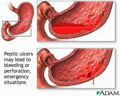 Bleeding Ulcer Diet Restrictions