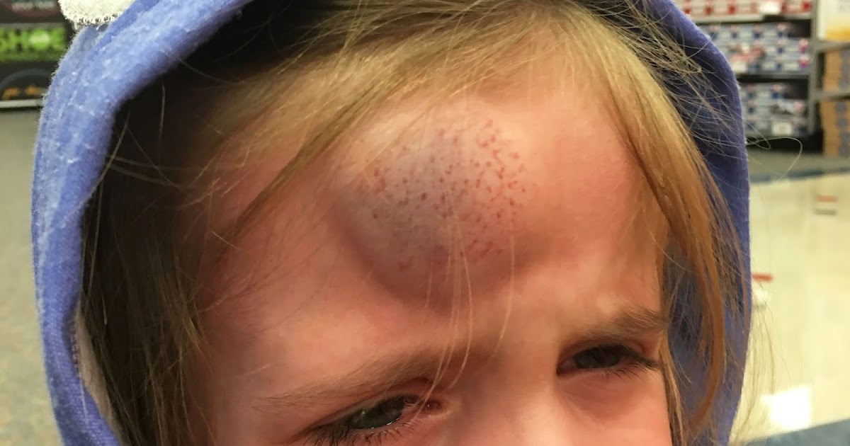 grass stains Fevers, vomiting and a head injury