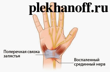 Туннельный синдром запястья, профилактика синдрома туннельного канала, упражнения при туннельном синдроме