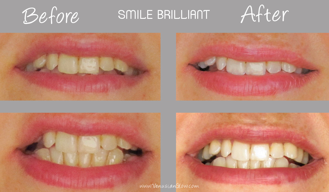 Review Smile Brilliant AtHome Teeth Whitening Venusian*Glow