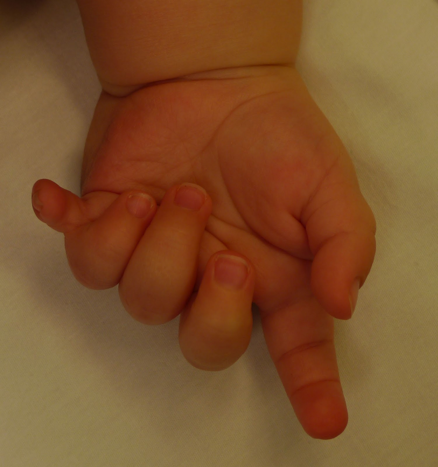 "Simple" Extra Digits Congenital Hand and Arm Differences