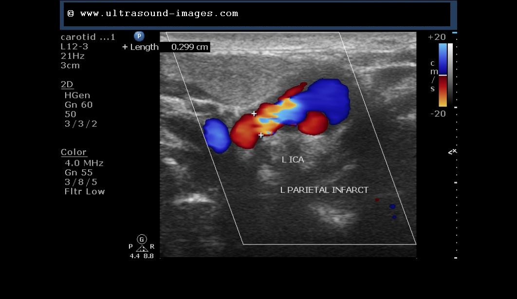 normal carotid doppler peak systolic velocity normal carotid doppler peak systolic velocity