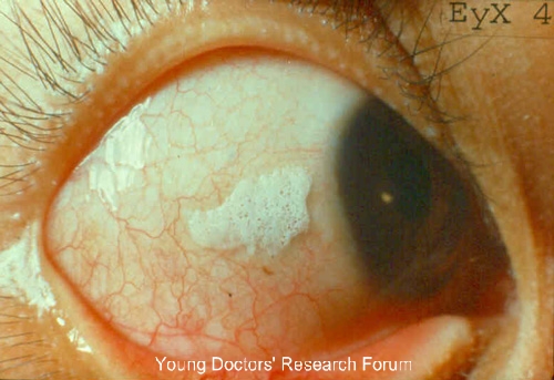 Young Doctors Research Forum Images For Conjunctival Xerosis