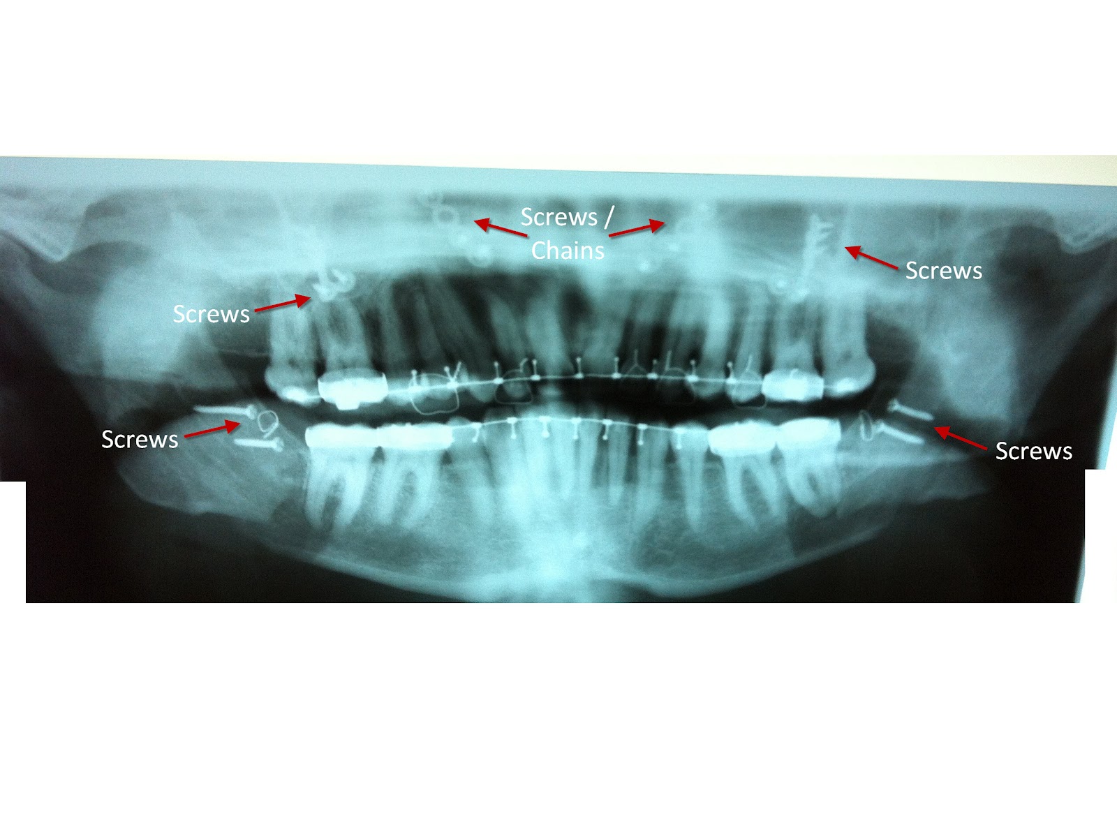 Double Jaw Operation The Road to Recovery