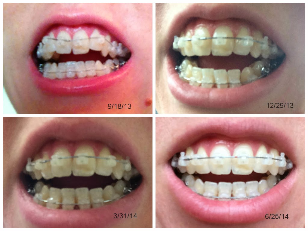 Braces and Open Bite Surgery