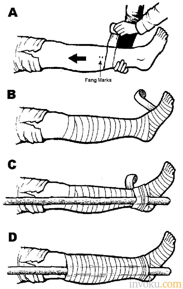 Carafeed Cari Dan Jelajahi Berbagai Cara Disini Gratis Pertolongan Pertama Pada Kecelakaan P3k Patah Tulang