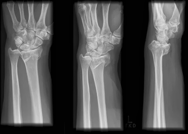 Wrist Fracture Types types of broken bones that occur near the wrist, but a typical wrist-3.bp.blogspot.com