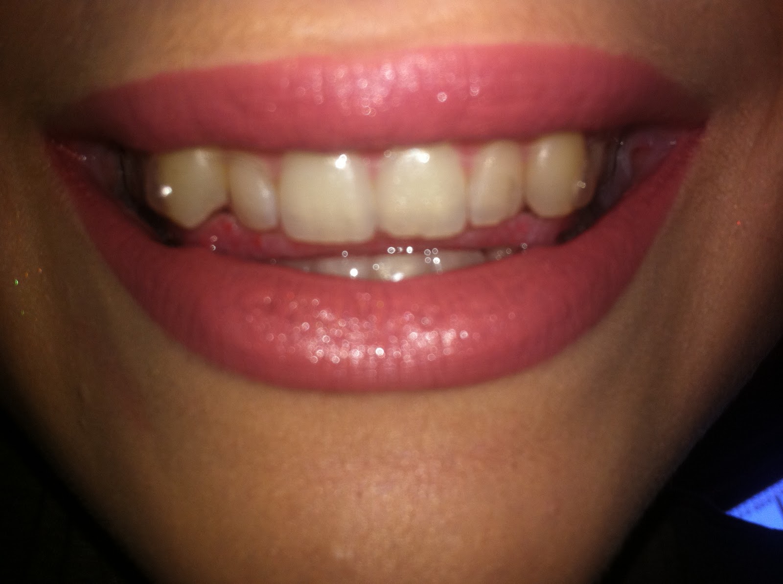 Shona's Invisalign Blog First day with Invisalign / Pictures with