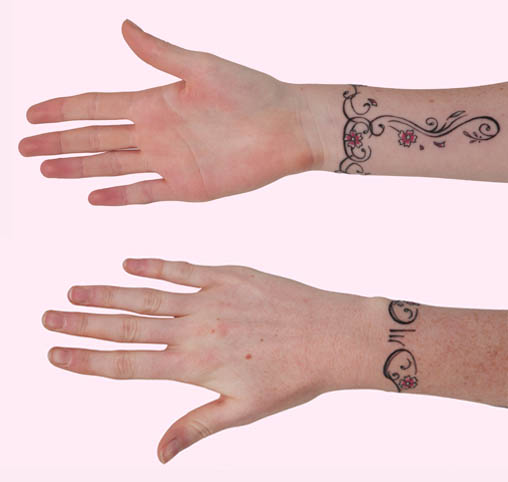 Tattoo Treatment Tattoo Treatment