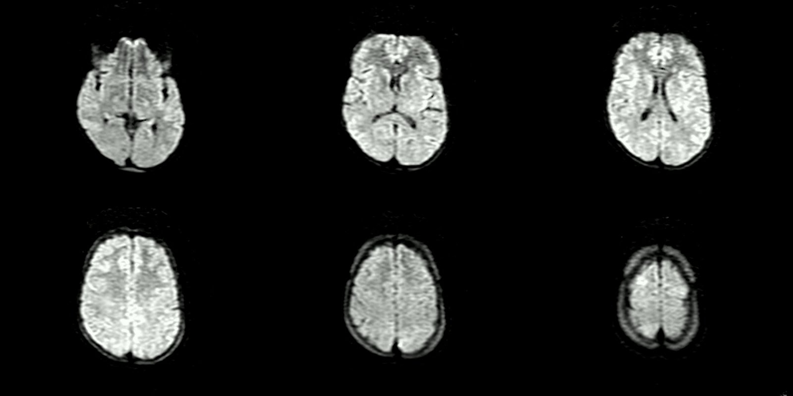 Brainstem Encephalitis