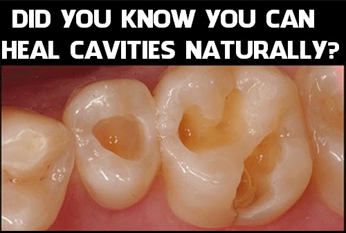 Can You Cure Cavities Naturally Can You Cure Cavities Naturally