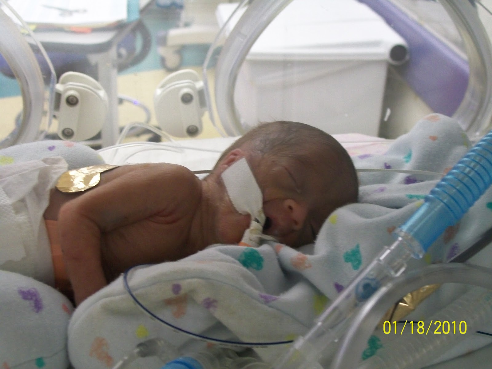 24 Weekers and Other Preemie Babies 11510 through 11810 PDA, Echo