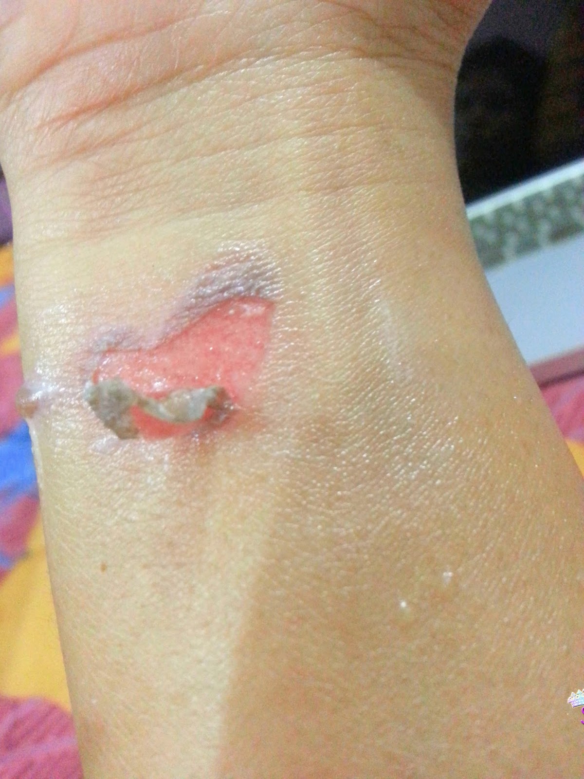 What Causes Burn Marks And How To Improve It In Plast vrogue.co