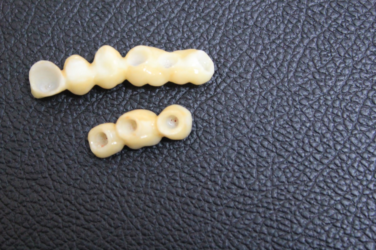 Zirconium bridges for teeth replacement with dental implants.