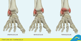 Fisioterapia - Recuperação de fraturas