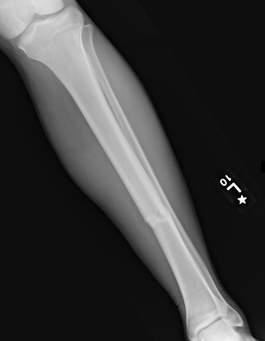 Roentgen Ray Reader: Isolated Tibial Diaphysis Fractures