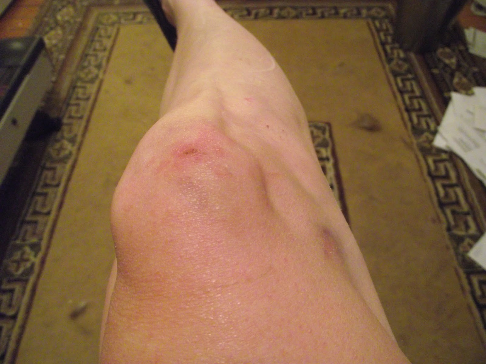 Infected Knee Scrape