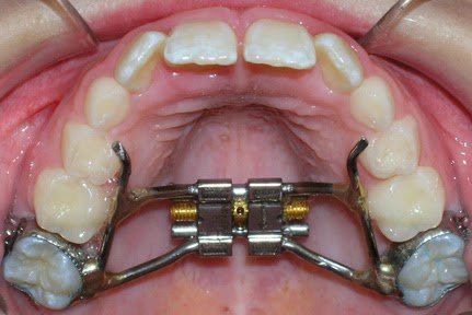 Blog by Orthodontist Nancy Phan, DDS, MS: Does my child need a palatal  expander?