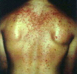 Types of steroid injections for rash