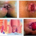 Obat Ambeien Generik thumbnail