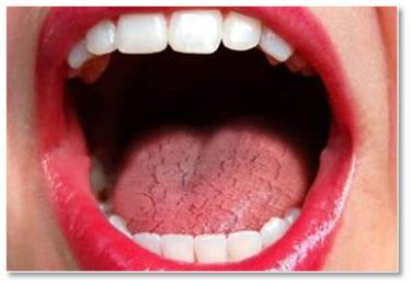 effetti collaterali della terapia oncologica: Xerostomia, bocca secca