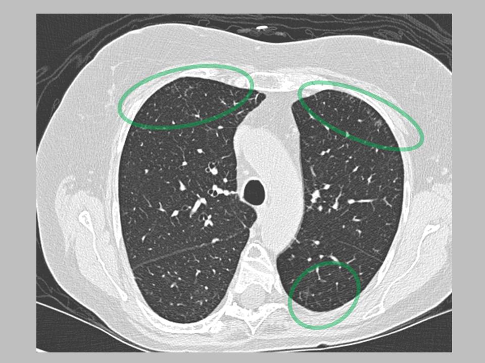 The Pump and the Tubes The Vasculitides ChurgStrauss Syndrome (CSS)