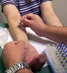 Is Skin Allergy Testing
